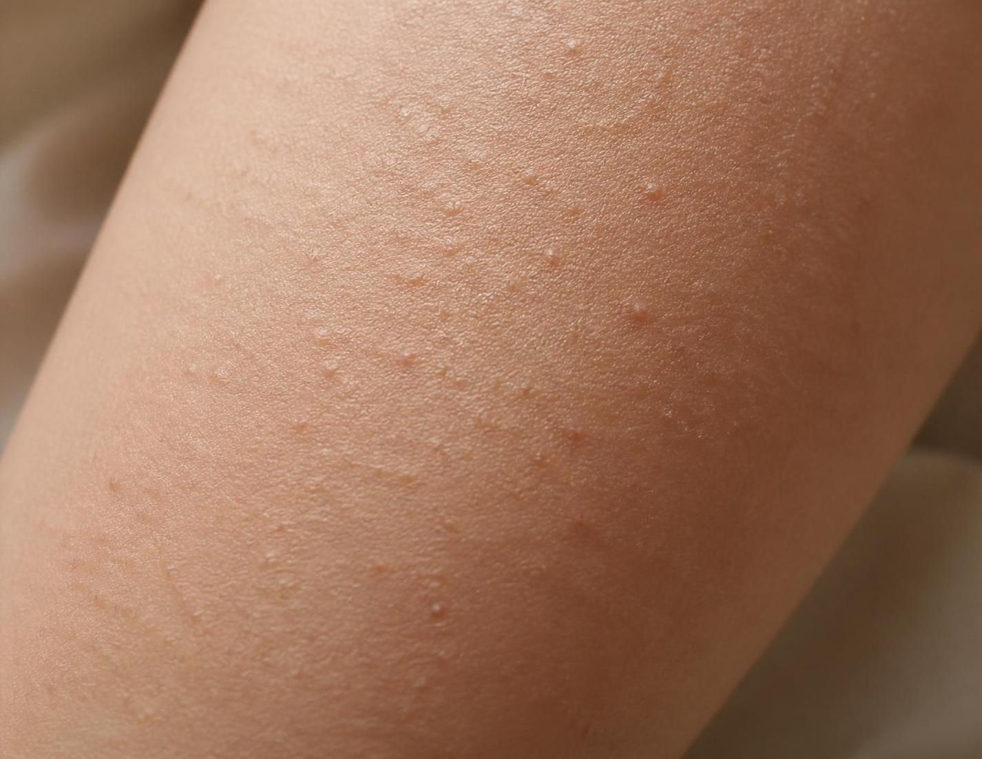 découvrez les remèdes de grand-mère efficaces pour apaiser la peau rugueuse causée par la kératose et retrouver un teint doux naturellement.