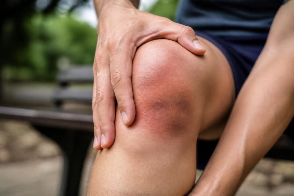 découvrez les symptômes clés de l'entorse du genou à ne pas négliger pour mieux reconnaître et traiter cette blessure courante.